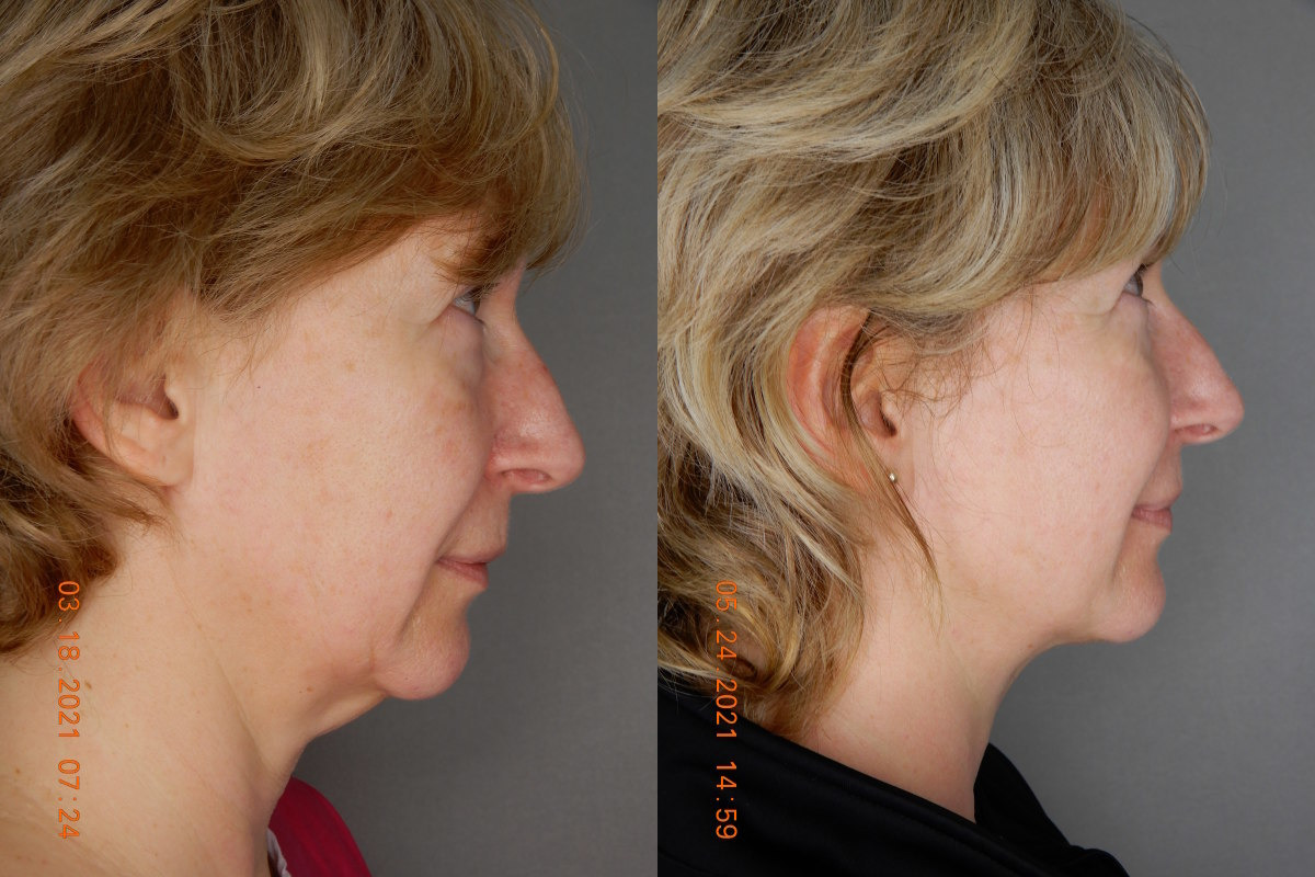 before and after neck lift