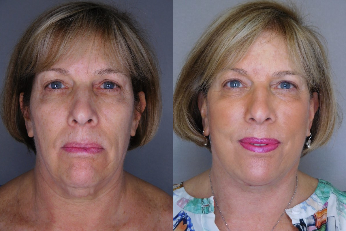 before and after neck lift