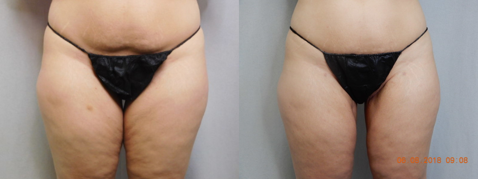 before and after thigh lift