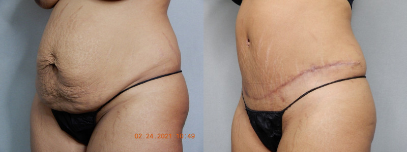 before and after tummy tuck