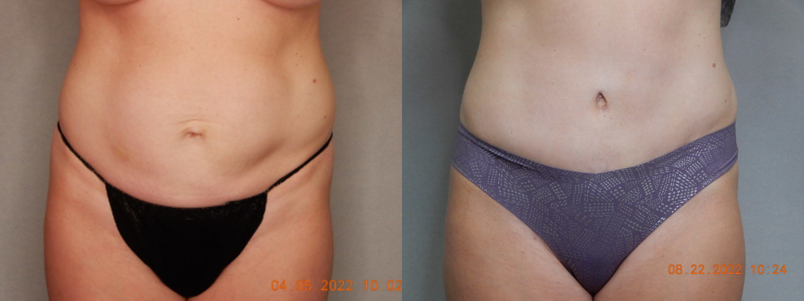 before and after tummy tuck