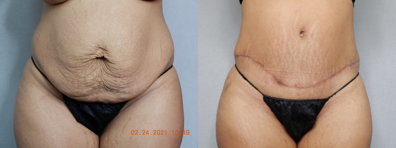 before and after tummy tuck