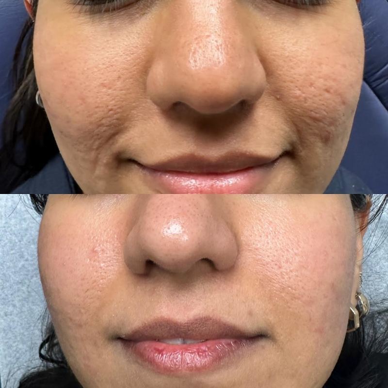 before and after halo bbl