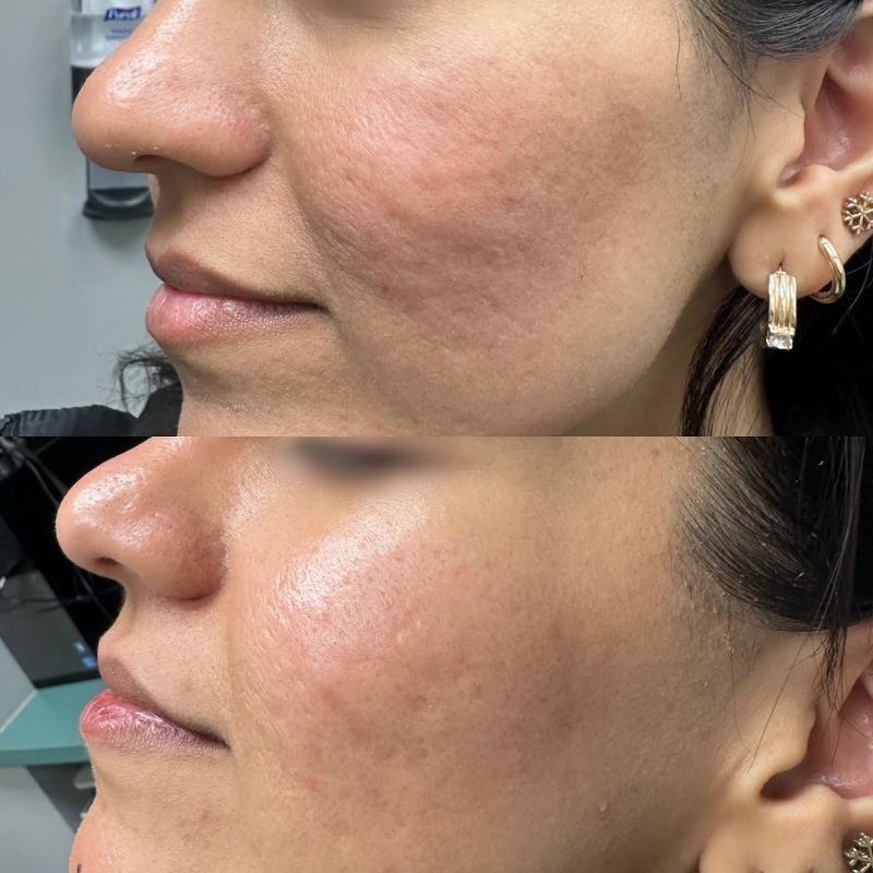 before and after halo bbl