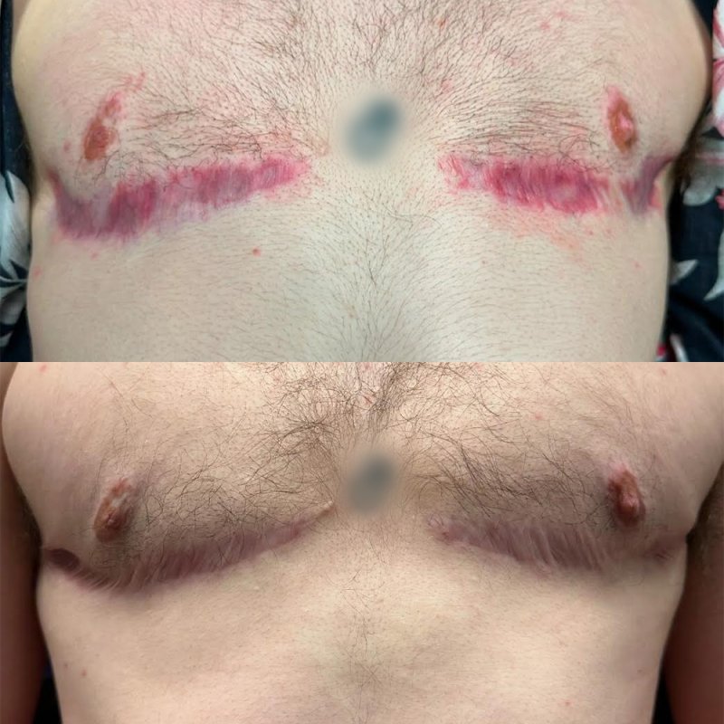 before and after halo bbl