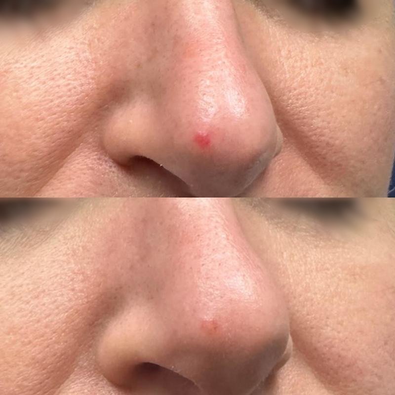 before and after halo bbl