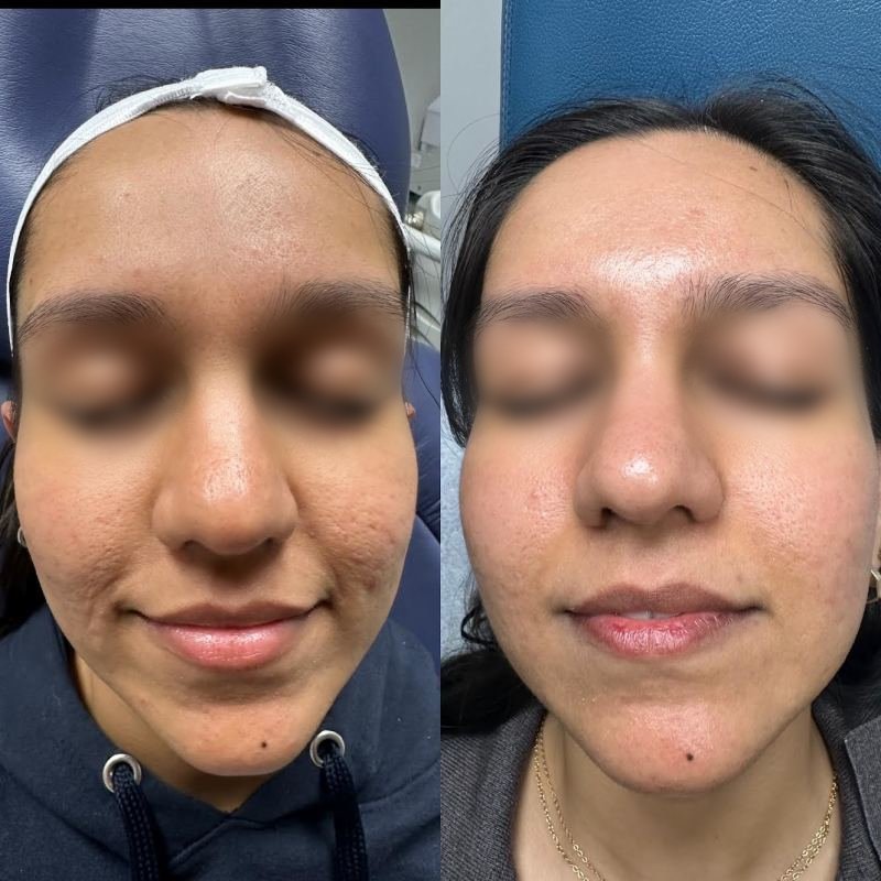 before and after halo bbl
