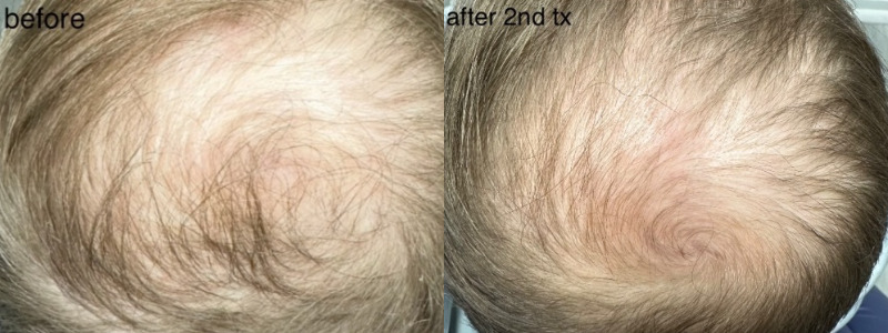 before and after prp hair restoration