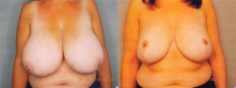 before and after breast reduction