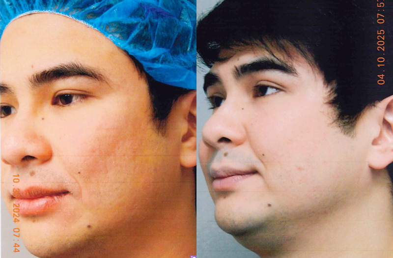 before and after co2 laser