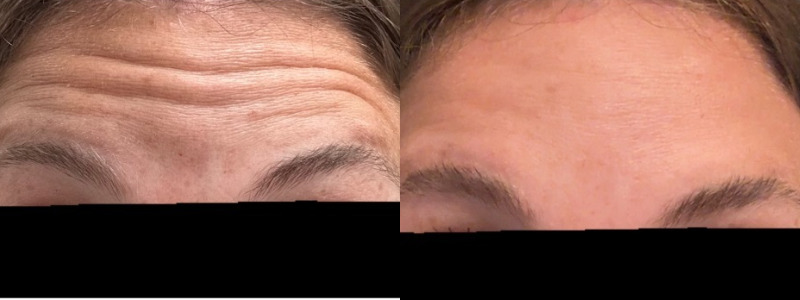 before and after dysport