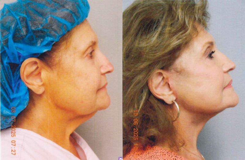 before and after facelift