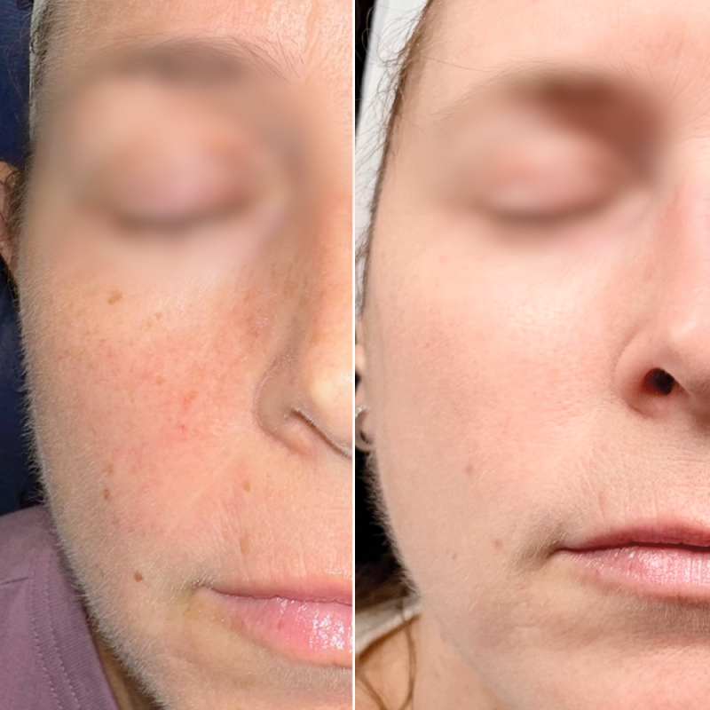 before and after halo bbl