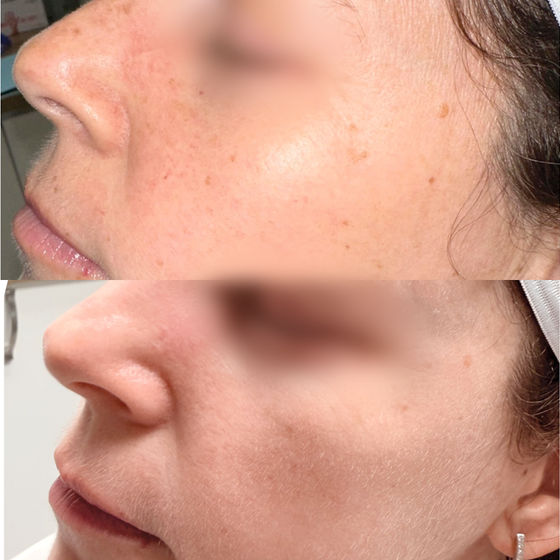 before and after halo bbl