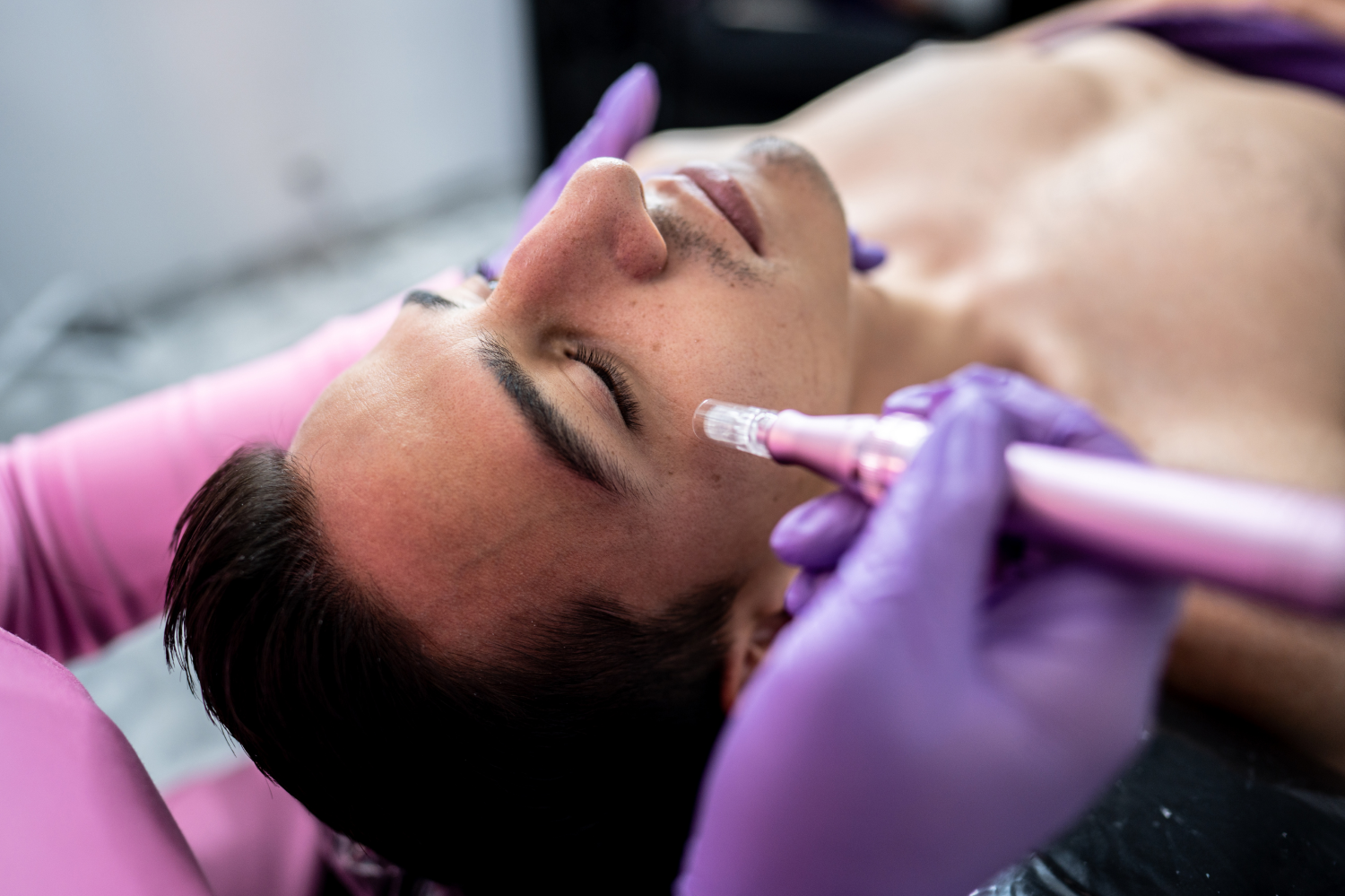 $650 Full Face OR $1,800 Package of 3 Vivace Microneedling Treatments