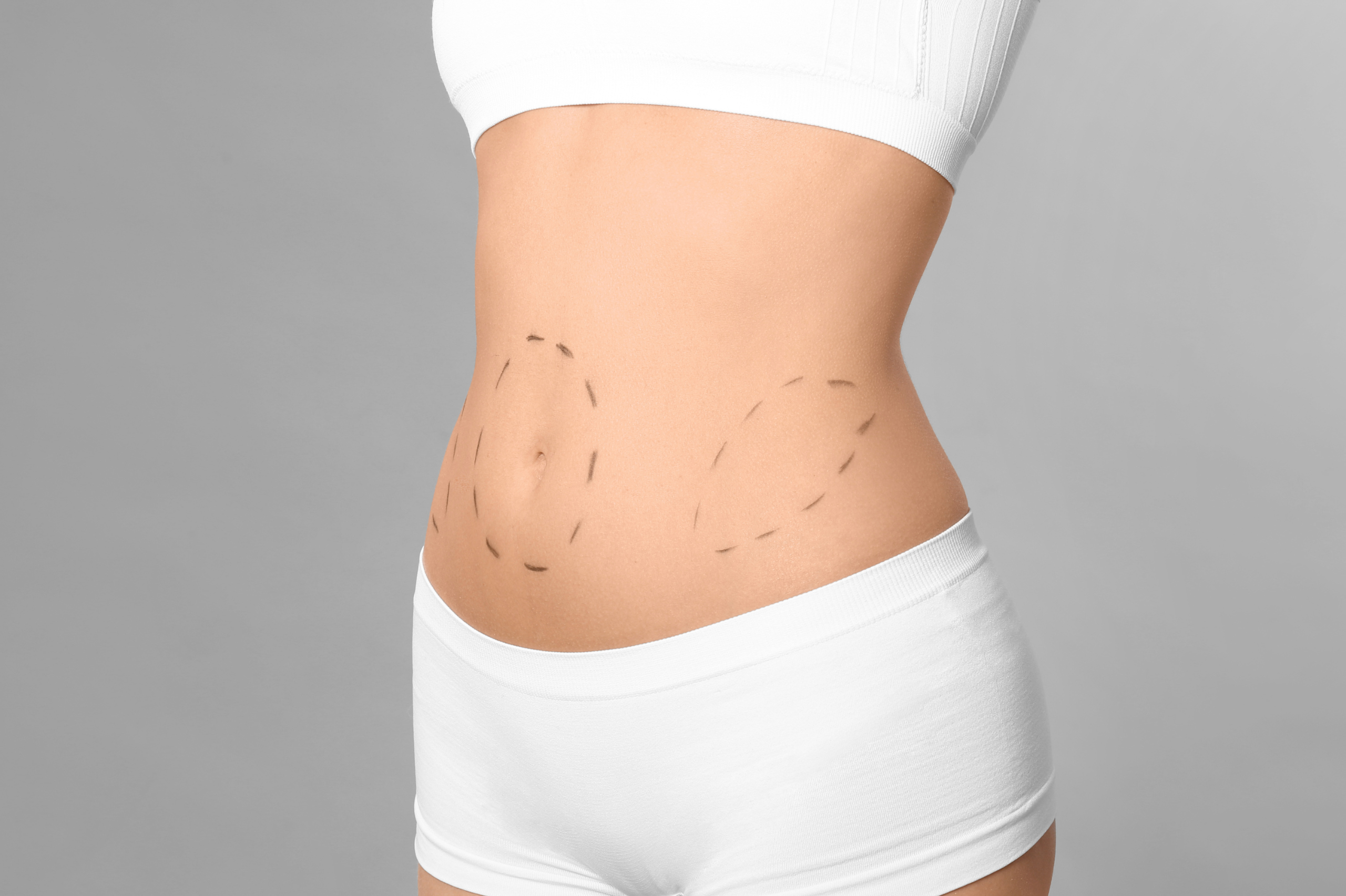 $1,000 Off Tummy Tucks