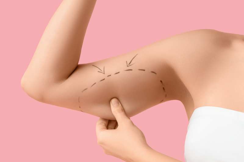 $600 Off Arm Lift (Brachioplasty)