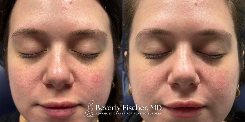 before and after chemical peels