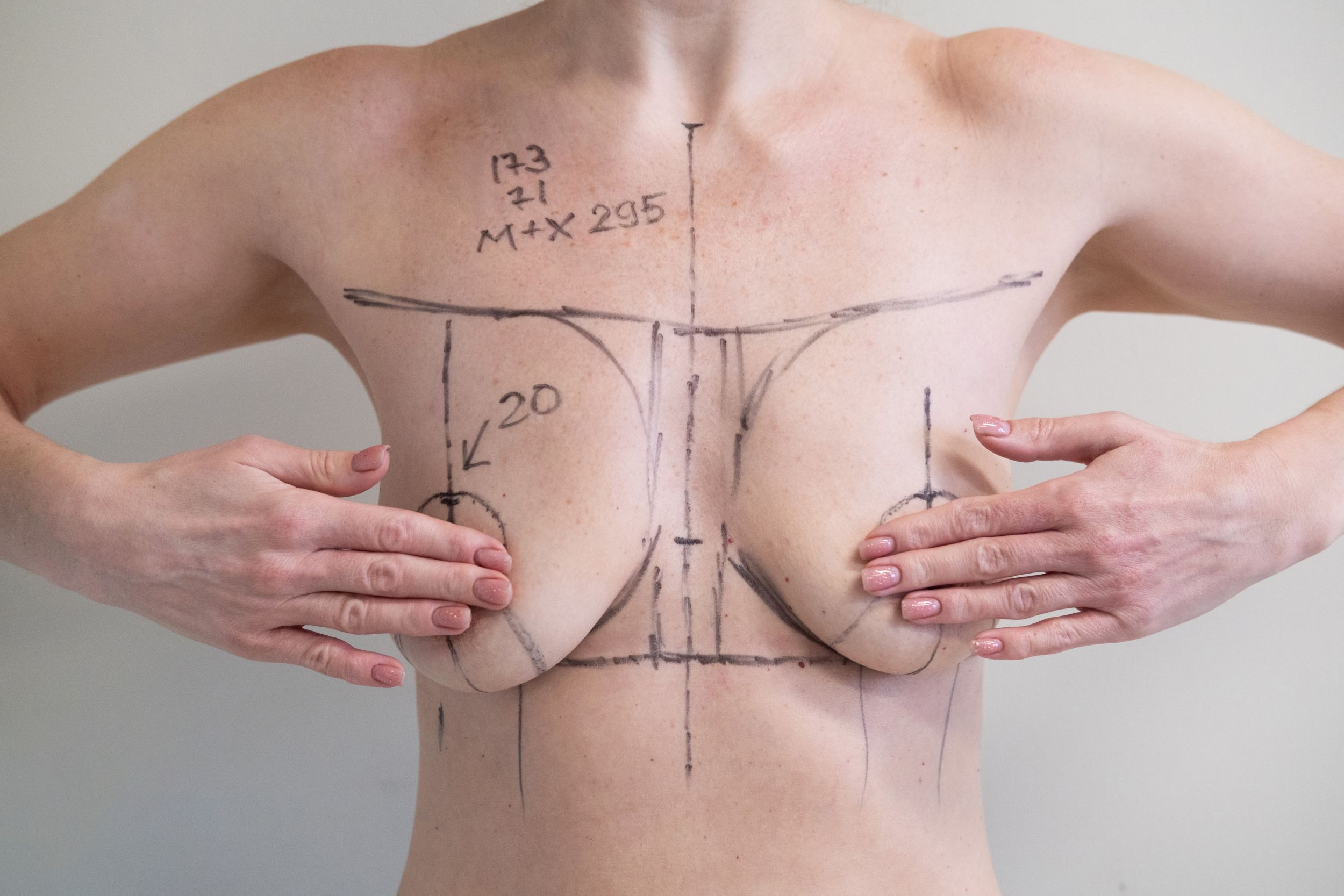 Breast Reduction and Lift Cost in Timonium, Maryland